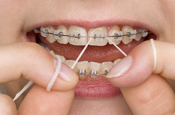 close up of someone flossing their braces
